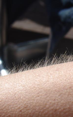 Ratunek dla suchej skóry w łuszczycy